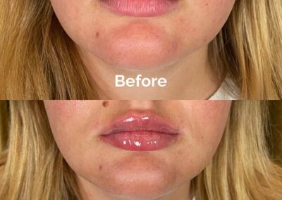 Before and After Results of Treatment at MediZen Institute in Columbus, OH 51