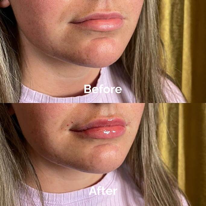 Before and After Results of Treatment at MediZen Institute in Columbus, OH 52