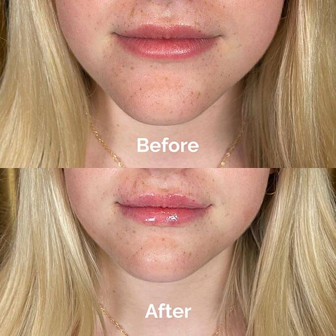 Before and After Results of Treatment at MediZen Institute in Columbus, OH 54