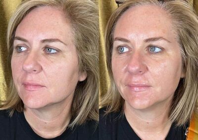 Before and After Results of Treatment at MediZen Institute in Columbus, OH 55