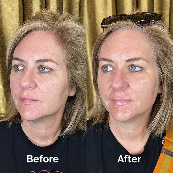 Before and After Results of Treatment at MediZen Institute in Columbus, OH 55