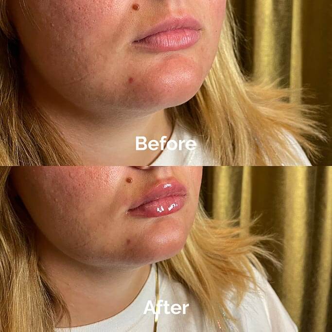 Before and After Results of Treatment at MediZen Institute in Columbus, OH