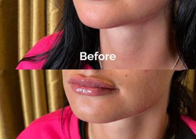Before and After Results of Treatment at MediZen Institute in Columbus, OH 57