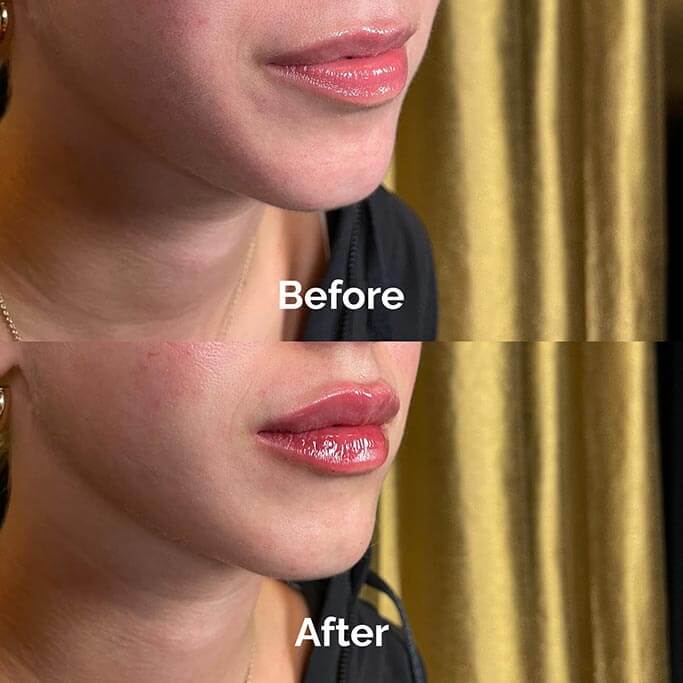 Before and After Results of Treatment at MediZen Institute in Columbus, OH 58