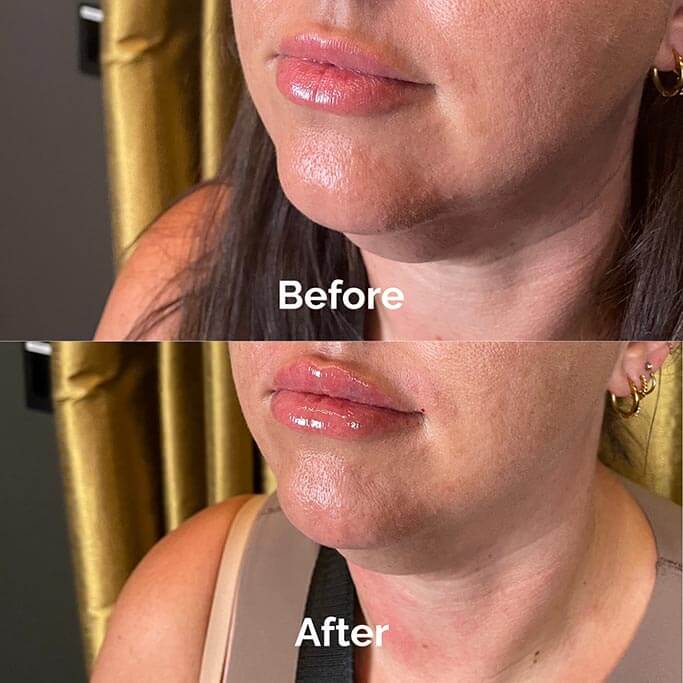Before and After Results of Treatment at MediZen Institute in Columbus, OH 59