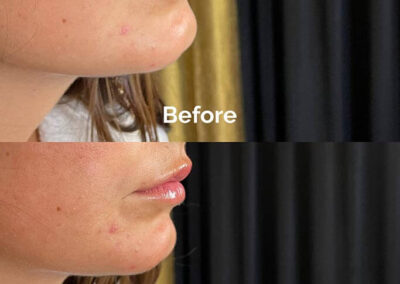 Before and After Results of Treatment at MediZen Institute in Columbus, OH 60