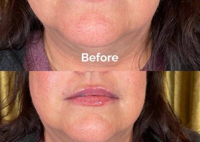 Before and After Results of Treatment at MediZen Institute in Columbus, OH 61
