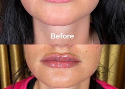 Before and After Results of Treatment at MediZen Institute in Columbus, OH 63