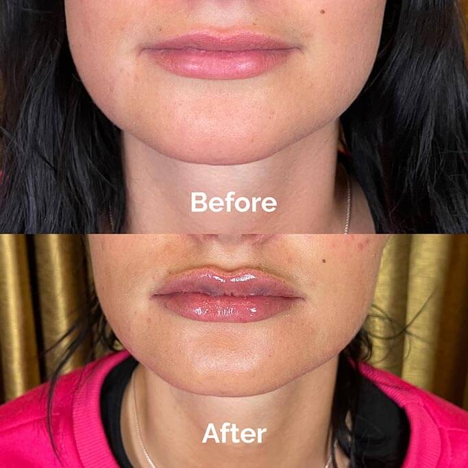 Before and After Results of Treatment at MediZen Institute in Columbus, OH 63