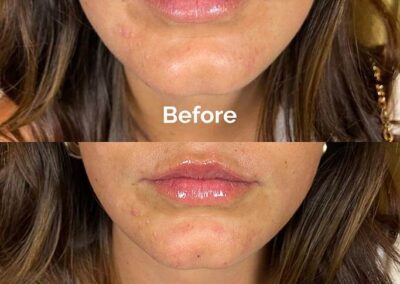 Before and After Results of Treatment at MediZen Institute in Columbus, OH 64