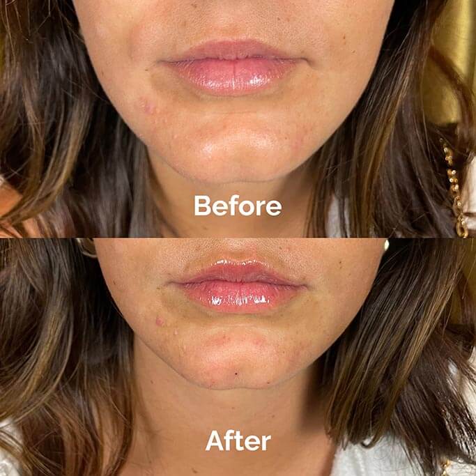 Before and After Results of Treatment at MediZen Institute in Columbus, OH 64