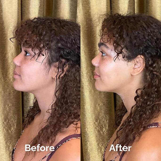 Before and After Results of Treatment at MediZen Institute in Columbus, OH 65