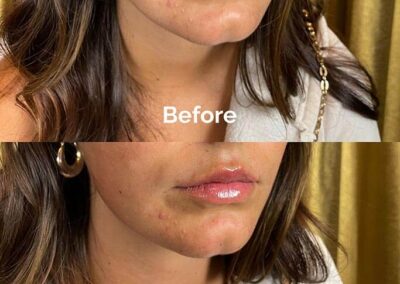 Before and After Results of Treatment at MediZen Institute in Columbus, OH 67