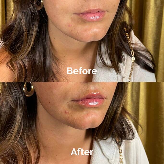 Before and After Results of Treatment at MediZen Institute in Columbus, OH 67