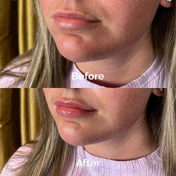 Before and After Results of Treatment at MediZen Institute in Columbus, OH 68