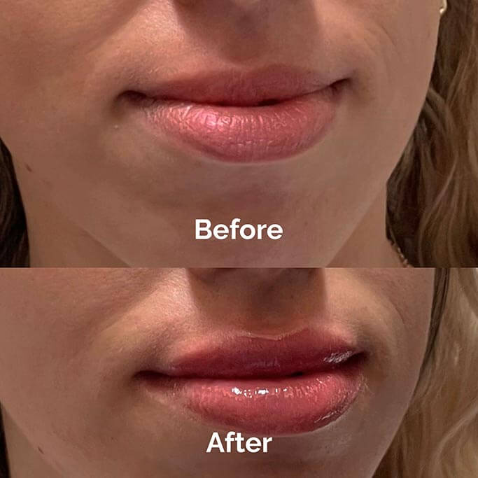 Before and After Results of Treatment at MediZen Institute in Columbus, OH 07