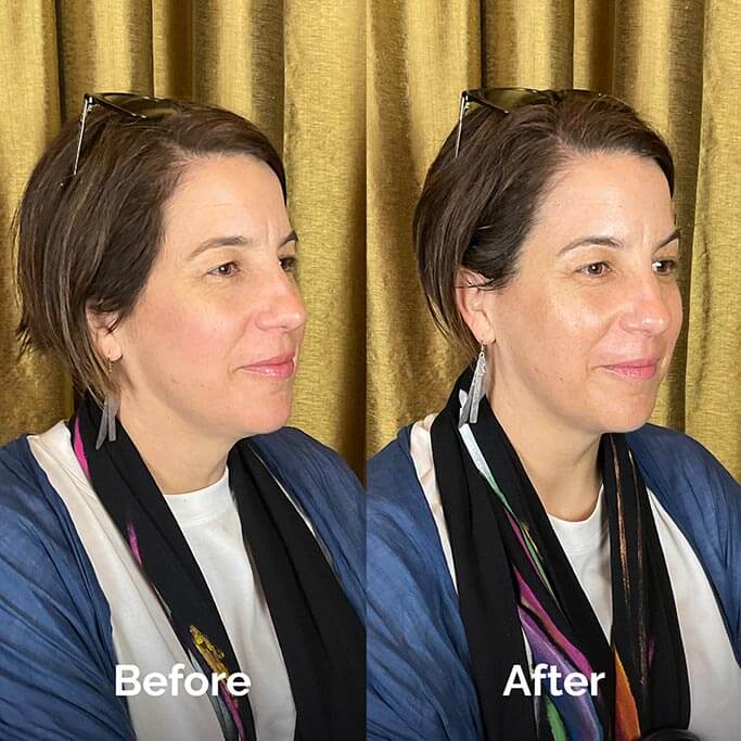 Before and After Results of Treatment at MediZen Institute in Columbus, OH 70
