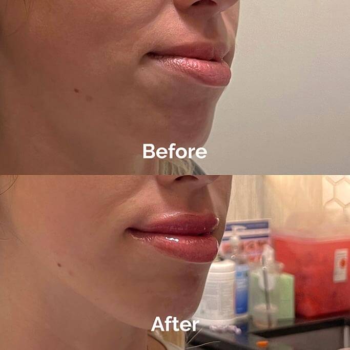 Before and After Results of Treatment at MediZen Institute in Columbus, OH 08