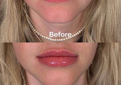 Before and After Results of Treatment at MediZen Institute in Columbus, OH 09
