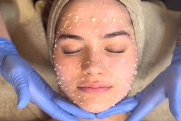 Liquid Microneedling at MediZen Institute