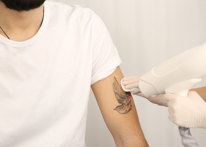 Tattoo removal in Columbus, OH