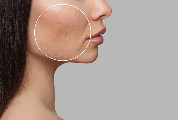 woman facing right with skin problem