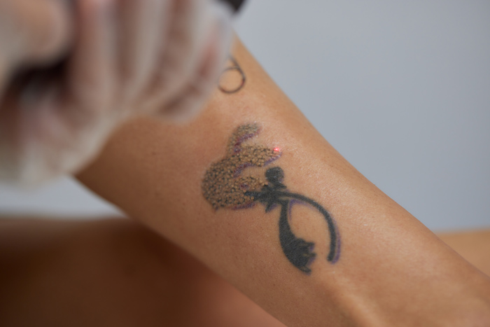 Wrist tattoo removal in Columbus, OH