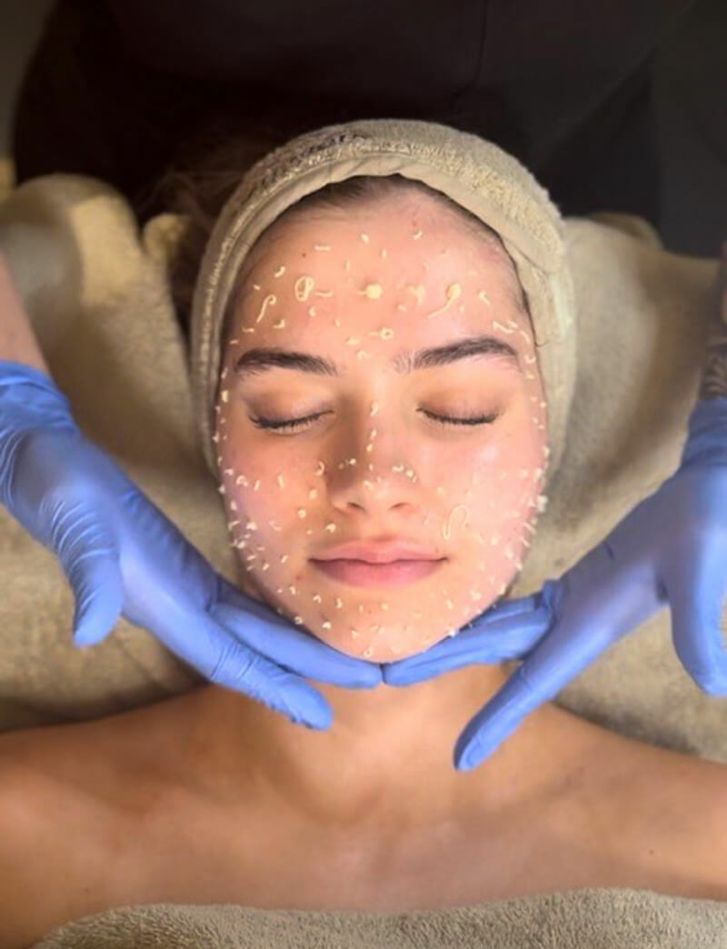 Young woman getting liquid microneedling treatment at MediZen Institute