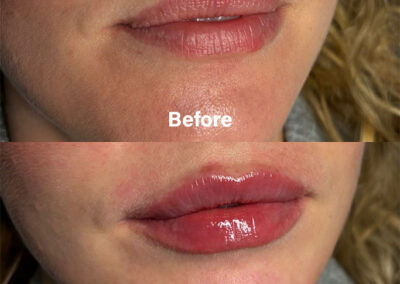 Before and After Results of Treatment at MediZen Institute in Columbus, OH 83