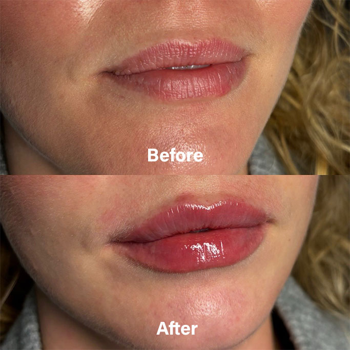 Before and After Results of Treatment at MediZen Institute in Columbus, OH 83