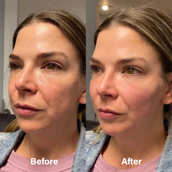 Before and After Results of Treatment at MediZen Institute in Columbus, OH 84