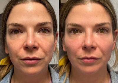 Before and After Results of Treatment at MediZen Institute in Columbus, OH 85