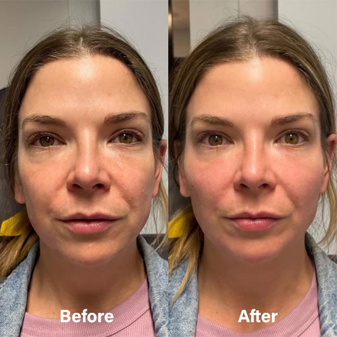 Before and After Results of Treatment at MediZen Institute in Columbus, OH 85