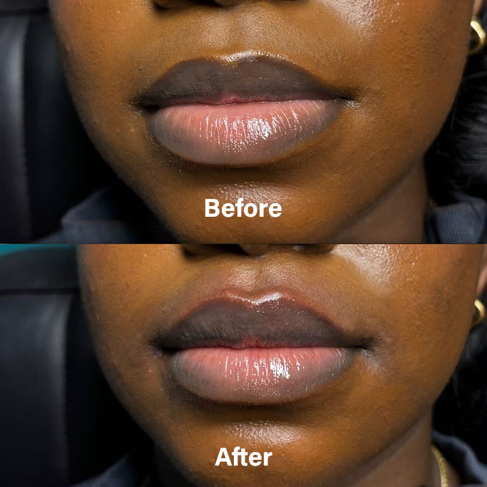 Before and After Results of Treatment at MediZen Institute in Columbus, OH 86