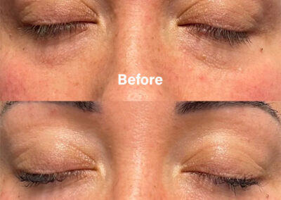 Before and After Results of Treatment at MediZen Institute in Columbus, OH 87