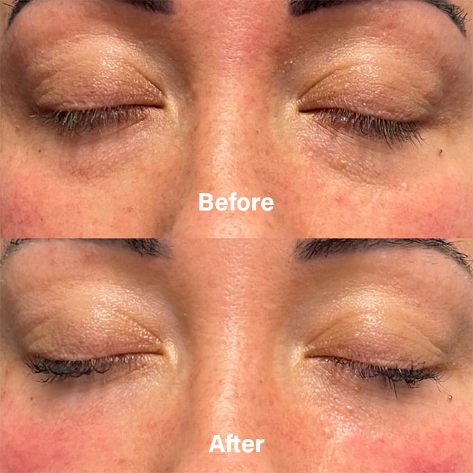 Before and After Results of Treatment at MediZen Institute in Columbus, OH 87