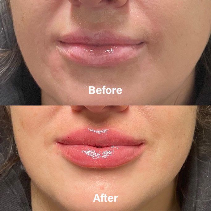 Before and After Results of Treatment at MediZen Institute in Columbus, OH 88