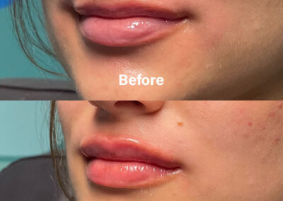 Before and After Results of Treatment at MediZen Institute in Columbus, OH 89