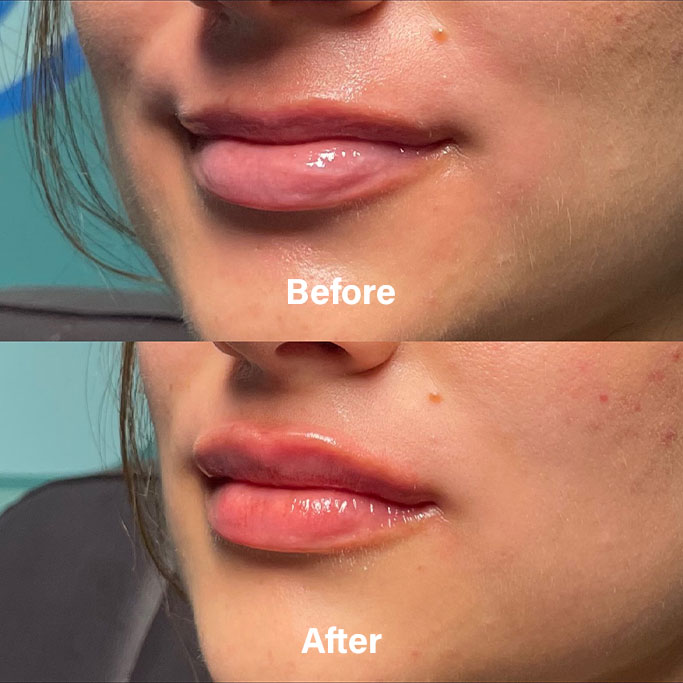 Before and After Results of Treatment at MediZen Institute in Columbus, OH 89