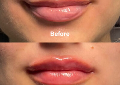 Before and After Results of Treatment at MediZen Institute in Columbus, OH 90