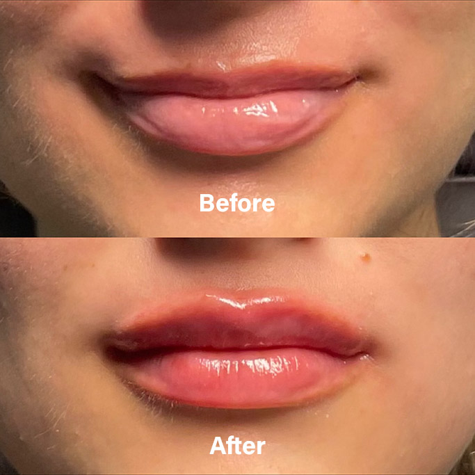 Before and After Results of Treatment at MediZen Institute in Columbus, OH 90